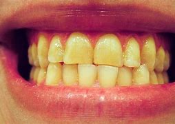 Image result for Car Dent Teeth Puller Tooth