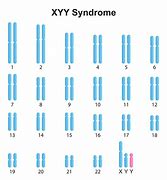 Image result for Jacobs Syndrome Karyotype