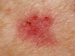 Image result for Skin Cancer Blemish