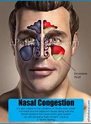 Image result for Nasal Congestion
