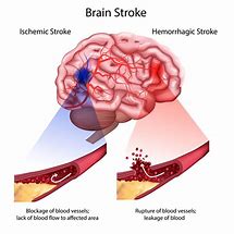 Image result for Stroke Anatomy