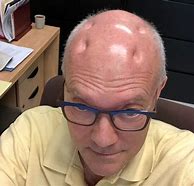 Image result for Dent On Head