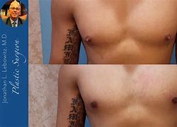 Image result for Gynecomastia Surgery