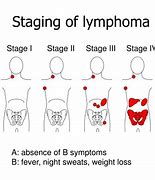 Image result for Stage 4 Lymphoma Cancer