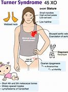 Image result for Turner Syndrome Characteristics