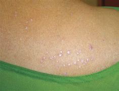 Image result for Skin Bumps From Vitamin B Complex