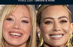 Image result for Hilary Duff Veneers Before and After