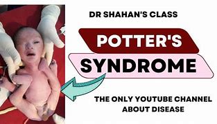 Image result for Potter's Syndrome