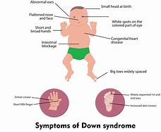 Image result for Down Syndrome Cells