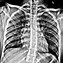 Image result for Crouzon Syndrome Radiology