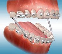 Image result for Forsus Orthodontic Appliance