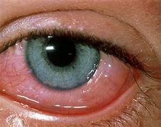 Image result for Eyes Burning Allergies