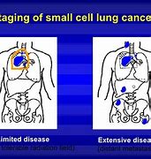 Image result for Extensive Stage Small Cell Lung Cancer