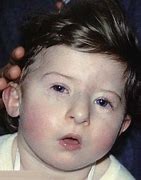 Image result for Syndrome S Difoerge