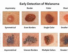 Image result for Stage 4 Melanoma Liver Cancer