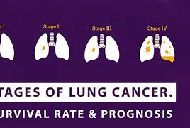 Image result for Stage 4 Lung Cancer Survivors