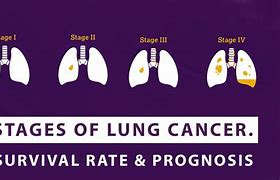 Image result for Lung Cancer Staging Stage 4