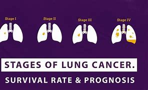 Image result for Final Symptoms of Stage 4 Lung Cancer