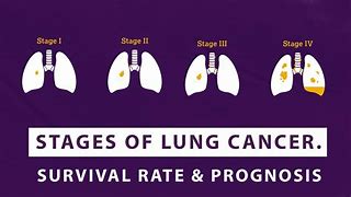 Image result for End-Stage Lung Cancer