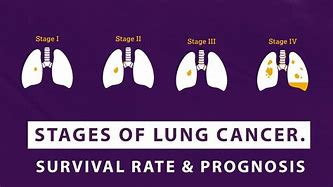 Image result for Lung Cancer Staging