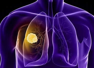 Image result for Prevention of Small cell lung cancer