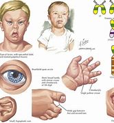 Image result for Down Syndrome Characteristics in Children