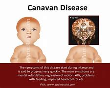 Image result for Chart for Canavan Disease