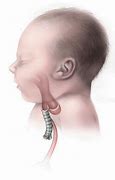 Image result for Feingold Syndrome in Children