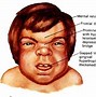 Image result for Hurler Syndrome Facies Human