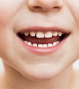 Image result for Dents in Teeth