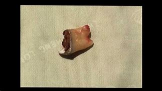 Image result for Rotten Wisdom Tooth