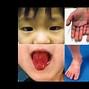 Image result for Kawasaki Disease in Children