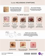 Image result for Signs of Melanoma