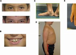 Image result for Person with XYY Syndrome