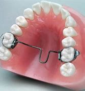 Image result for TPA Orthodontic Appliance