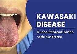 Image result for Kawasaki Disease Signs and Symptoms