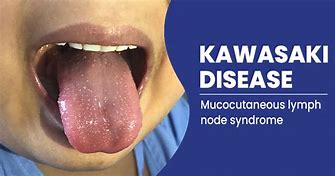 Image result for Atypical Kawasaki Disease
