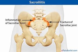 Image result for Sacroiliac Joint Pain