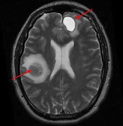 Image result for Stage 4 Metastatic Brain Cancer