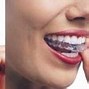 Image result for Orthodontic Retainer