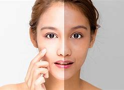 Image result for Skin Lightening Treatment