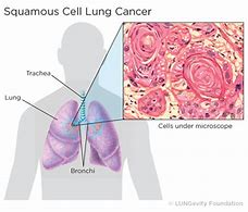 Image result for Squamous Non-Small Cell Lung Cancer