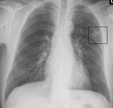 Image result for Lung Tumor