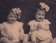 Image result for Mengele Twins Sewn Together