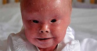 Image result for Baby with Harlequin Ichthyosis