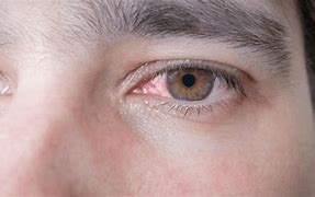 Image result for Injure Eye