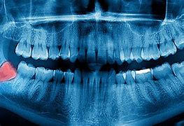 Image result for Wisdom Tooth Impaction