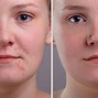 Image result for Girl with Blemish