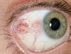 Image result for Eyes Scratched by Contact Lens Inside Out