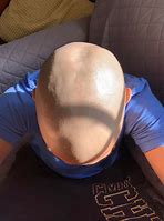 Image result for Dent in the Back of Head